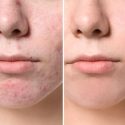 Curso de Soluções para Acne Facial Online