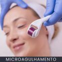 Microagulhamento curso online